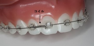 ワイヤー　矯正　動く　仕組み