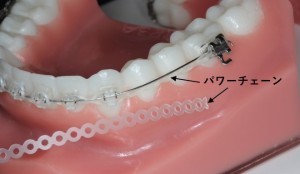 ワイヤー　矯正　動く　仕組み