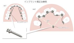 ガミースマイル　アンカースクリュー　歯列矯正