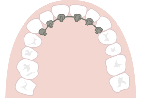 部分矯正 横浜駅徒歩１分 横浜駅前歯科 矯正歯科