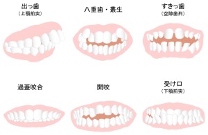 ワイヤー　矯正　動く　仕組み