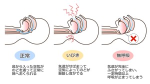 睡眠　歯並び　矯正