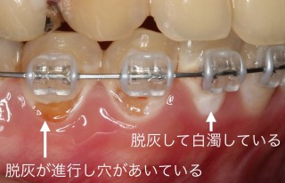 裏側矯正　表側矯正　虫歯になりにくい